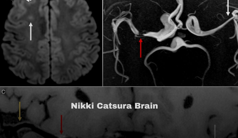 Nikki Catsura Brain