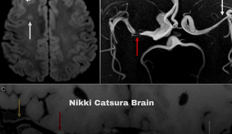 Nikki Catsura Brain: Everything You Need to Know